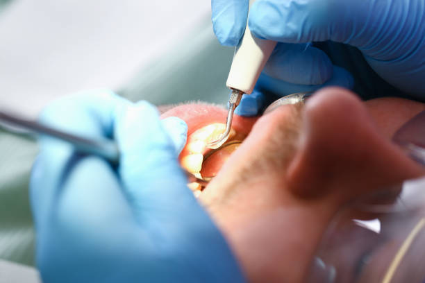 Best Emergency Treatment for Dental Infections or Abscesses in Centerville, TN